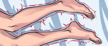 Síndrome de las piernas inquietas